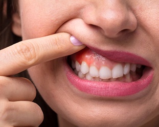 Woman lifting lip to show her swollen gums