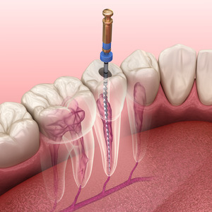 Diagram of a root canal